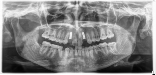 Pre-treatment panoramic dental image