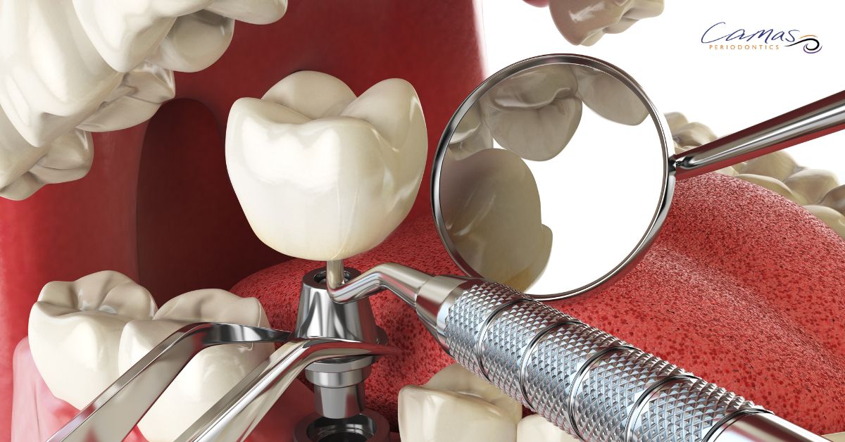 Dental Implants