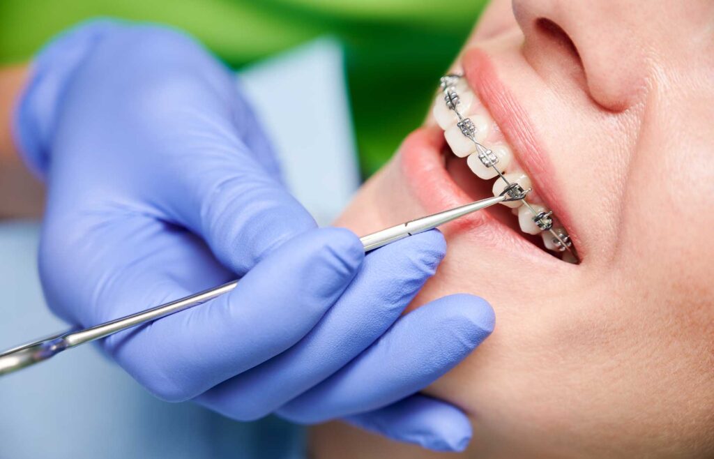 Orthodontic Tooth Uncovering