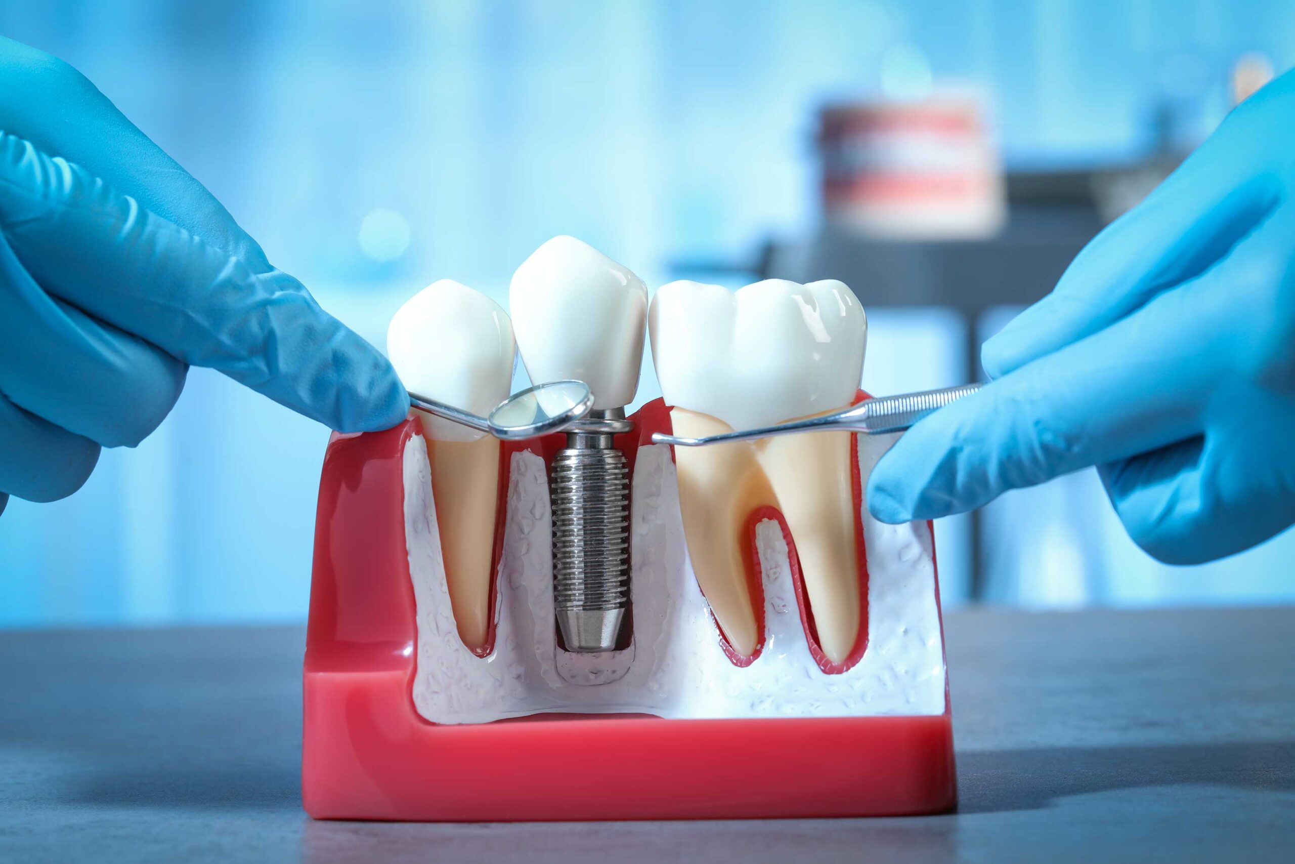 Dental Implants Procedure